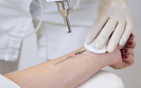 Laserowe usuwanie tatuazu – przebieg zabiegu i przeciwwskazania